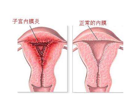 [淮安治疗子宫内膜炎医院]一起来看看