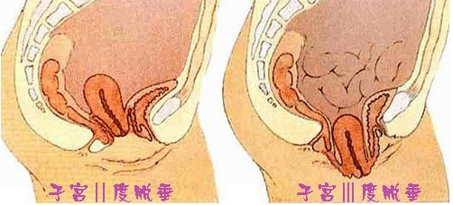 老年人子宫脱垂的原因