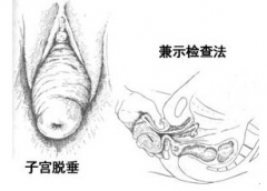 子宫脱垂手术后的注意事项有哪些