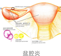 淮安治疗盆腔炎好的妇科医院?盆腔炎为何久治不愈?
