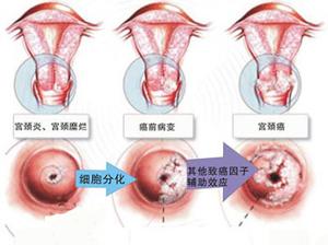宫颈糜烂2度症状