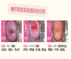 1度宫颈糜烂有多严重