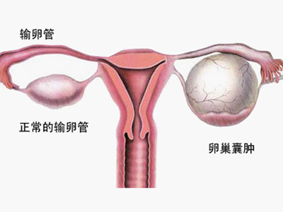 b超检查卵巢囊肿