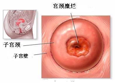 宫颈糜烂花多少钱治疗,淮安治疗糜烂的价格