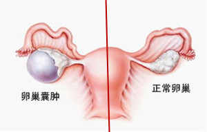 卵巢囊肿的症状,有多可怕_出现这6种症状时,要小心