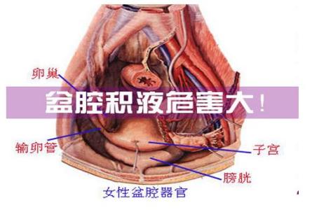 警惕！【盆腔积液表现】3大异常表现，快来对号入座！ 