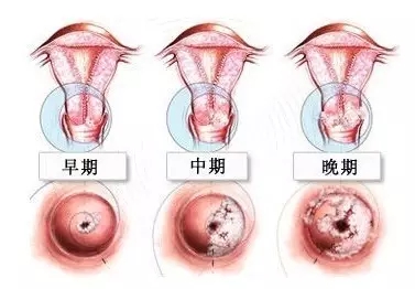 【疑问】宫颈糜烂可以自愈吗？医生提醒，宫颈糜烂需重视！