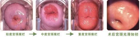 宫颈糜烂二度严重嘛?看完四大危害,小伙伴们都惊呆了!
