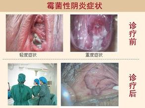 【霉菌性阴炎怎么治】4大霉菌性阴道炎日常饮食禁忌!
