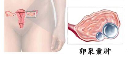卵巢囊肿做手术危险吗?卵巢囊肿治疗要及早,谨防癌变!