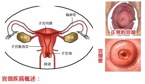 宫禁糜烂是怎么引起的?揭秘这4大罪魁因素!