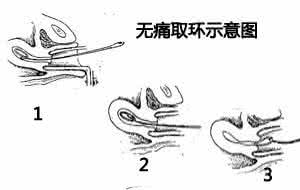 【图解】取环手术全过程_带你具体了解取环的每步骤!