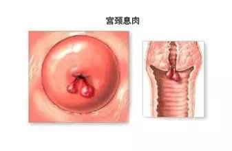 子宫息肉是怎么回事?快戳!史上超全子宫息肉疾病解答!