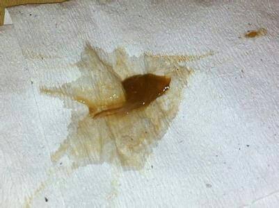 没有来月经但是有褐色的分泌物,肿么肥事?