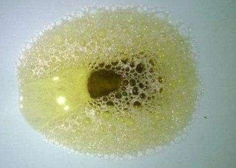 正常的尿液有泡沫吗?不应该!如有需当心,警惕三种疾病!