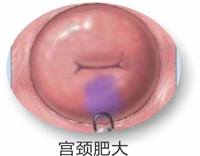 淮安女性患上宫颈肥大有哪些症状表现