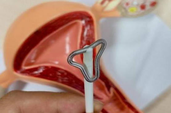 淮安取环要多少钱一次?女性取环后应该注意什么?